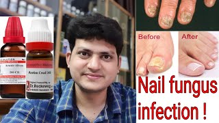 Nail fungus  Homeopathic Medicine for Nail fungus infection  Explain [upl. by Rahab47]