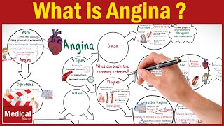 Pharmacology CVS 16 What is Angina Pectoris  Types of Angina Symptoms Causes and Treatment [upl. by Eaton]