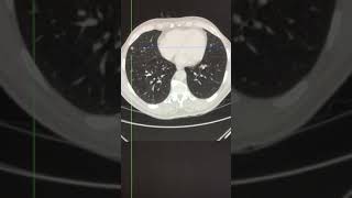 CT assessment  intrapulmonary lymph nodes [upl. by Jari159]