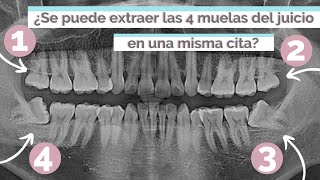 ¿SE PUEDEN EXTRAER LAS 4 MUELAS DEL JUICIO EN UNA MISMA CITA [upl. by Owiat]