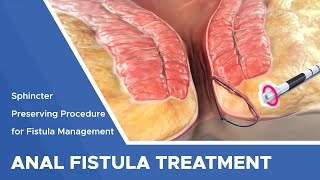 Closure of Fistula Tract with Laser [upl. by Wildon]