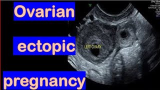 Ultrasound Diagnosis Of Ovarian Ectopic Pregnancy [upl. by Justen]