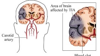 Transient Ischemic Attack TIA [upl. by Airretal76]