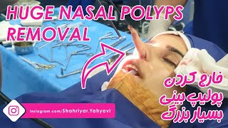 Huge Nasal Polyps Removal By Dr Shahriyar Yahyavi [upl. by Nyrrek]