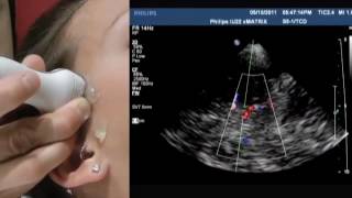 How To Transcranial Doppler [upl. by Ahsertal467]