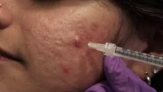 Watch amp Learn Intralesional injections [upl. by Johan]