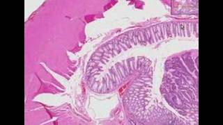 Histopathology Colon Adenocarcinoma [upl. by Matuag]