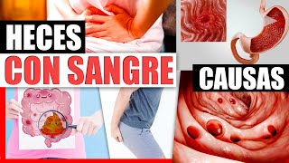 Sangre En Las Heces  Causas Y Tratamiento Natural Para Hemorroides Diverticulitis Ulceras Y Mas [upl. by Enihsnus]