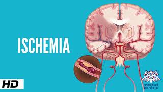 Ischemia Causes Signs and Symptoms Diagnosis and Treatment [upl. by Eblehs]