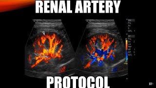 Renal Artery Doppler Protocol  Sonoquickies [upl. by Annatnom]