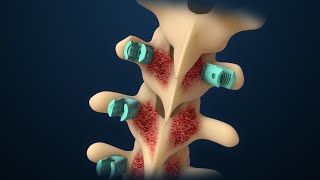 Scoliosis  Scoliosis Surgery  Nucleus Health [upl. by Ennirak801]