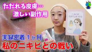 【ニキビケア】皮膚科で処方された薬が効き過ぎる件！実録密着1ヶ月間【ももかチャンネル】 [upl. by Sonny117]