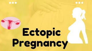 what is Ectopic pregnancy [upl. by Arabrab]