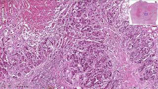 Hepatocellular Carcinoma  Histopathology [upl. by Elton242]