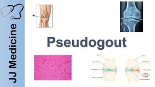 Pseudogout  Pathophysiology Symptoms and Treatment [upl. by Oigaib]