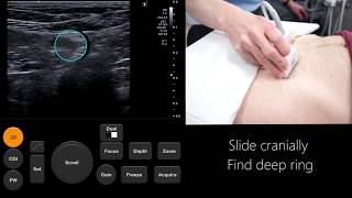 Ultrasound Tutorial InguinalFemoral Hernia Assessment  Radiology Nation [upl. by Nurat]