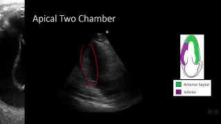 PointofCare Echo Regional Wall Motion Abnormalities [upl. by Rediah]