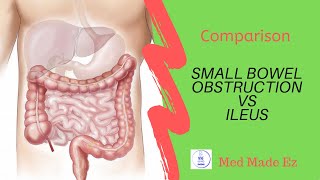 SBO vs Ileus  What is the difference [upl. by Ranchod773]