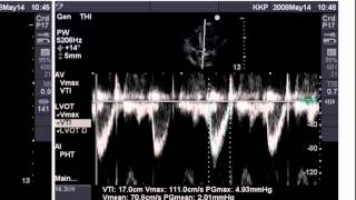 Point of Care Echo Stroke Volume Determination [upl. by Eitak472]