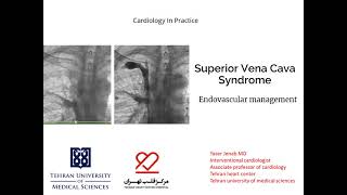 SVC syndrome Endovascular management [upl. by Zobias]