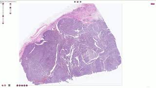 Papillary Renal Cell Carcinoma  Histopathology [upl. by Natika]