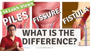 Piles  Fisure  Fistula  Difference explained  Dr Vishal Tomar  Open Consult [upl. by Sharla]