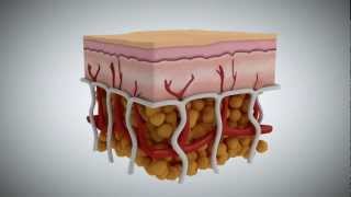 Cellulite What It Is What Causes It and How to Treat It [upl. by Fredie]