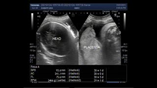 Ultrasound Video showing Hydrops fetalis Soft tissue edeme and Fetal pleural effusion [upl. by Quillon654]