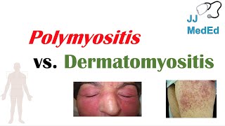 Mystery Diagnosis  Polymyositis Part I [upl. by Neelhsa326]