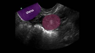 POCUS 1st Trimester Pregnancy Case 4  Ectopic Pregnancy [upl. by Jandel60]