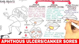 Aphthous Ulcers  Canker Sores  Pathophysiology Triggers Types amp Treatment [upl. by Pernick554]