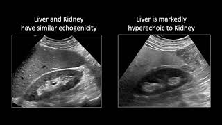 GI Imaging  Hepatic Steatosis and Cirrhosis [upl. by Aluin964]