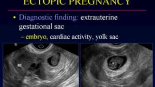 Sonographic Evaluation of Ectopic Pregnancy [upl. by Arlina419]