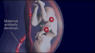 Fetal Hidrops Nedir Nedenleri Nelerdir I Prof Dr Arda Lembet [upl. by Lletniuq93]