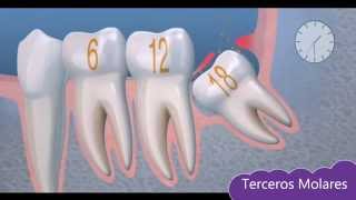 Tema 5 Cirugía Oral Terceros Molares [upl. by Johannes936]