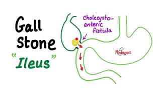 Gall Stone Ileus [upl. by Notselrahc]