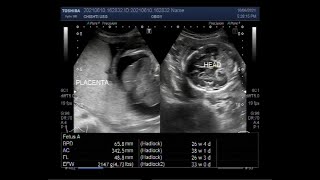 Two large Encephaloceles Hydrops fetalis pericardial effusion ascites and soft tissue edema [upl. by Analeh]