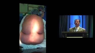 Anesthesia for Cesarean Delivery in the Obese Patient [upl. by Annelise447]