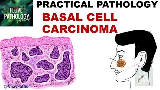 BASAL CELL CARCINOMA Clinical features amp Morphology [upl. by Isak]