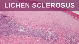 Lichen Sclerosus  Pathology mini tutorial [upl. by Greeson]