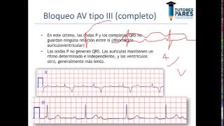 Arritmias en el electrocardiograma [upl. by Drahnreb219]