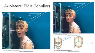 Radiographic Positioning of the TMJs [upl. by Eemaj]