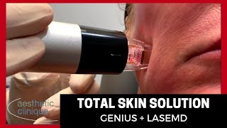 Total Skin Solution  Genius  LaseMD [upl. by Sivrup]