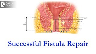 Best treatment for fistula  Dr Parameshwara C M [upl. by Uriia497]