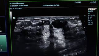 Intraductal Papilloma Sonography [upl. by Ethelred]