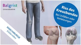 Kreuzbandriss operative Behandlung vordere Kreuzbandruptur [upl. by Arotahs]