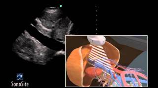 How to Inferior Vena Cava Ultrasound Exam 3D Video [upl. by Gascony557]