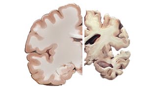 Alzheimers and the Brain [upl. by Ttereve]