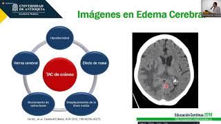 Anterior Cerebral Artery  Anatomy Tutorial [upl. by Papst]