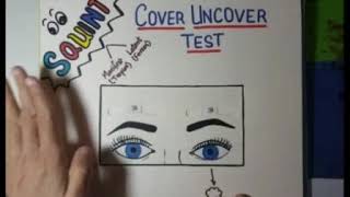 Types of squint and Cover uncover test [upl. by Nnylanna]